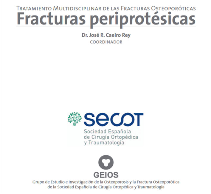 Tratamiento Multidisciplinar de las Fracturas Osteoporóticas Fracturas periprotésicas