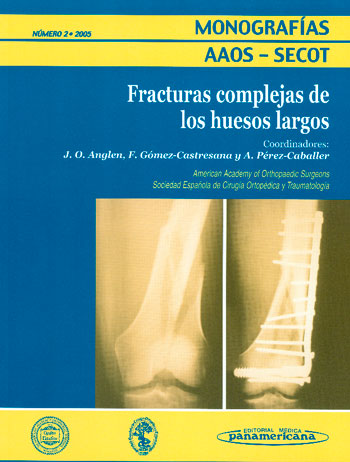 Fracturas complejas de los huesos largos